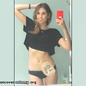 Uncover-Ostomy-12-Year